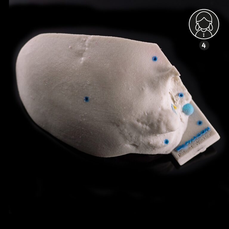 Patient with temporal bone "Winkler" – 4 years old – atresia