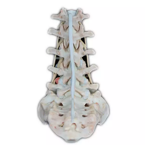 Digihuman 3D Printing Model-Lumbar Disc Herniation Model