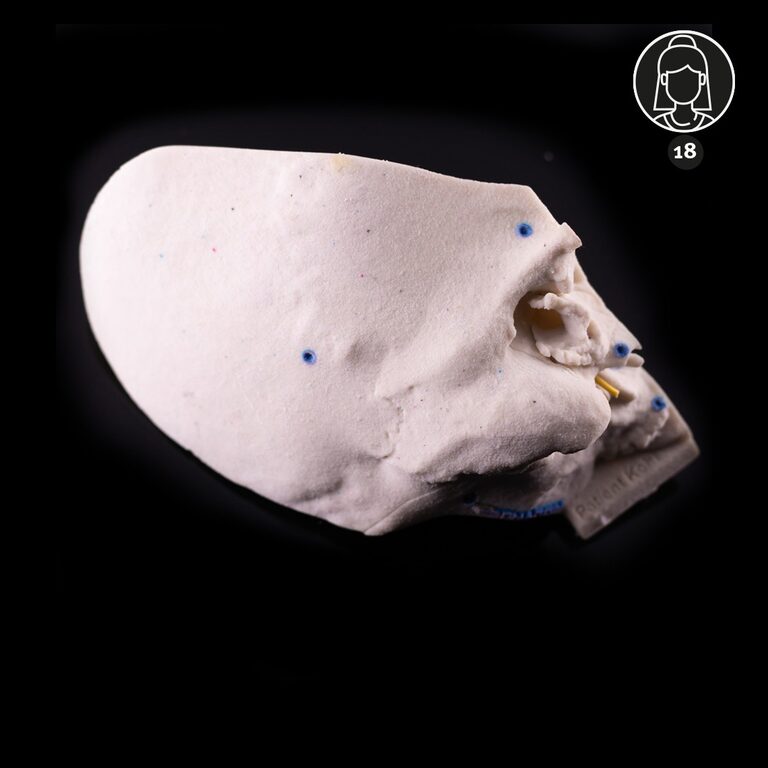 Temporal bone patient "Kohl" – 18 years old – hypoplasia of the auricle and vestibular apparatus