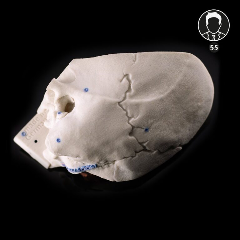 Temporal Bone Patient “Schmidt” – 55 years old – normal anatomy